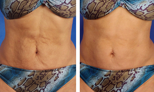 Skin tightening