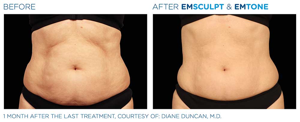 Dr. Kang Emsculpt NEO Erie PA - results photo 